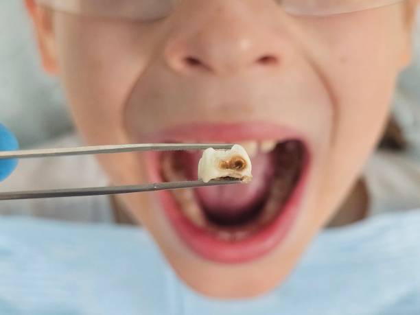 Best Dentist for Severe Toothache  in Richwood, LA